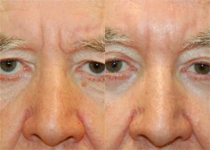 Eyelid Surgery Before & After Gallery - Patient 428470 - Image 1