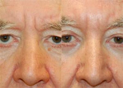Eyelid Surgery Before & After Gallery - Patient 122406016 - Image 1