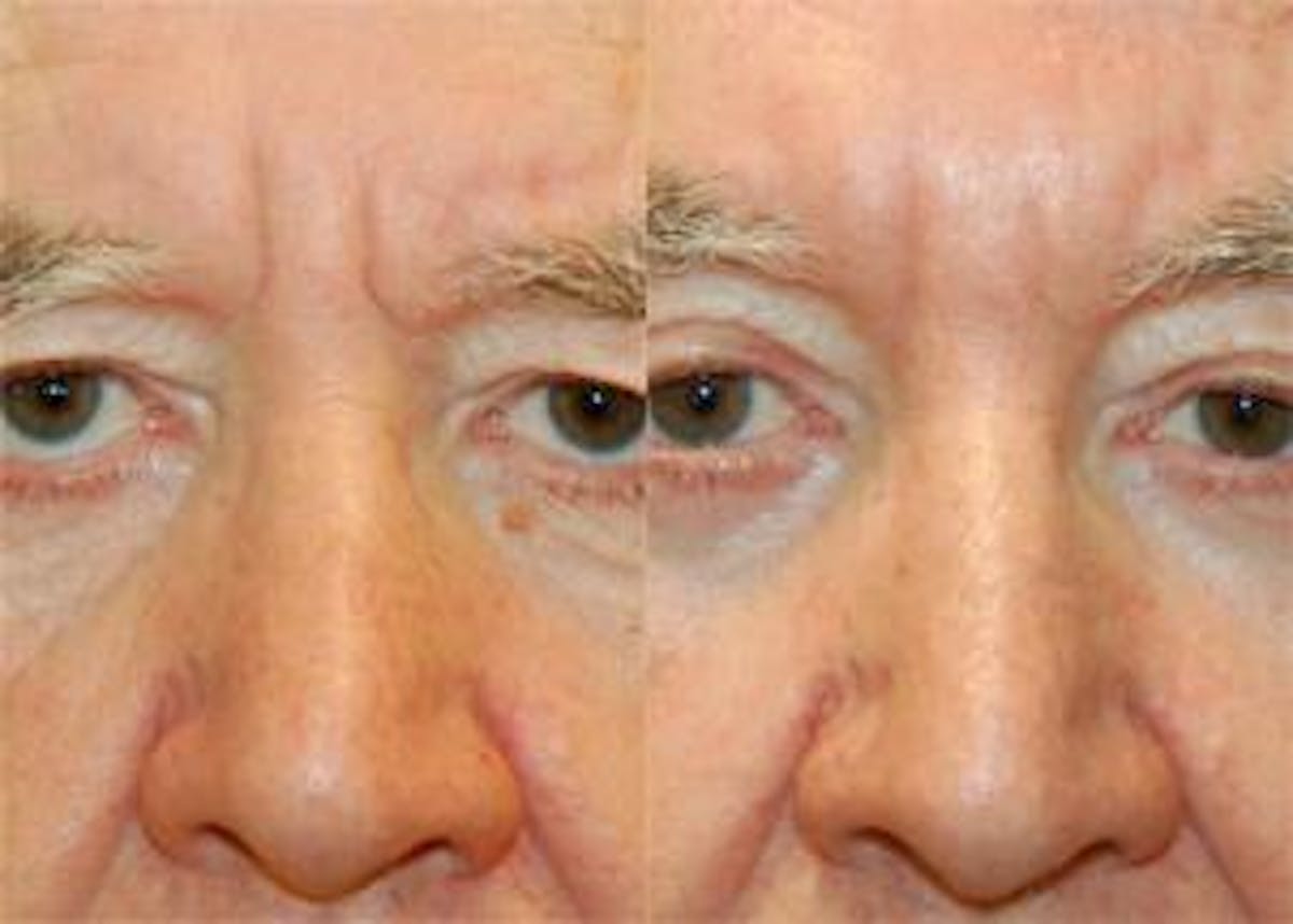 Eyelid Surgery Before & After Gallery - Patient 122406016 - Image 1