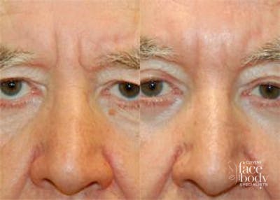 Eyelid Surgery Before & After Gallery - Patient 428470 - Image 1