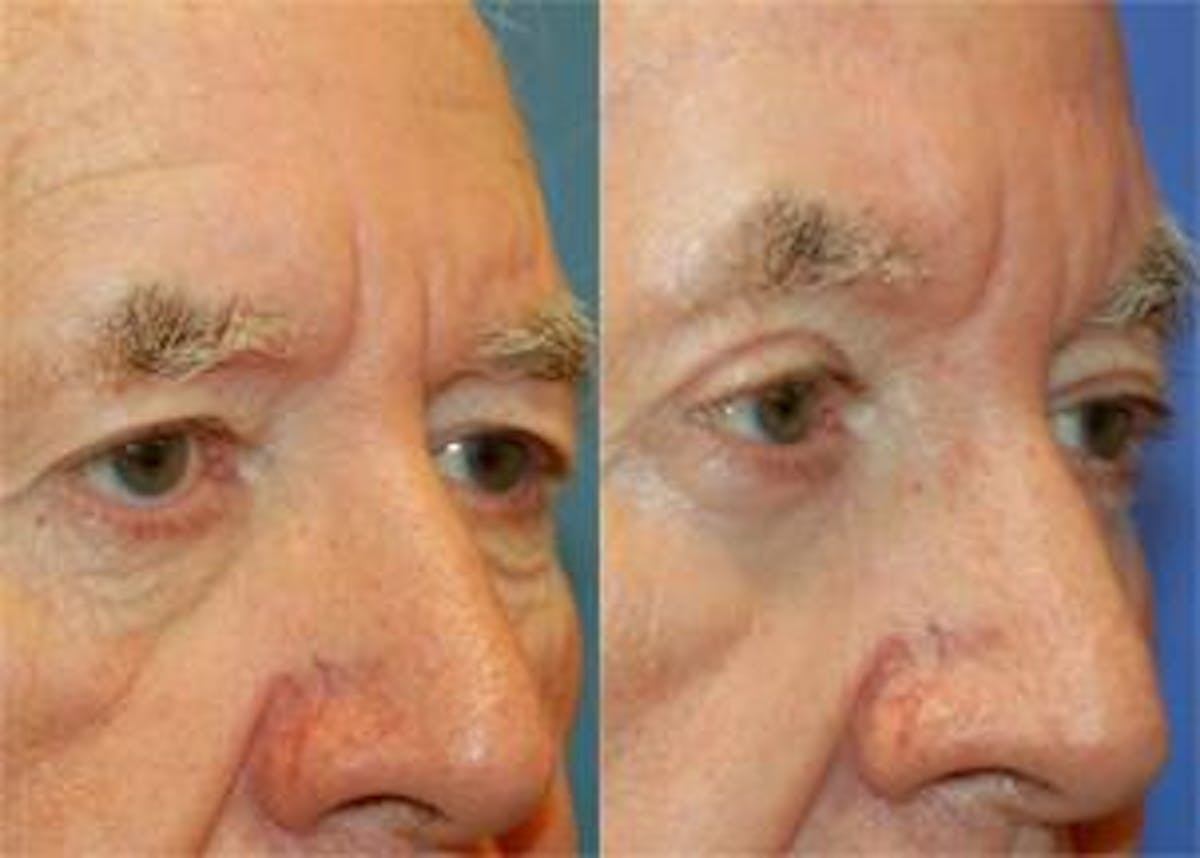 Eyelid Surgery Before & After Gallery - Patient 122406016 - Image 2
