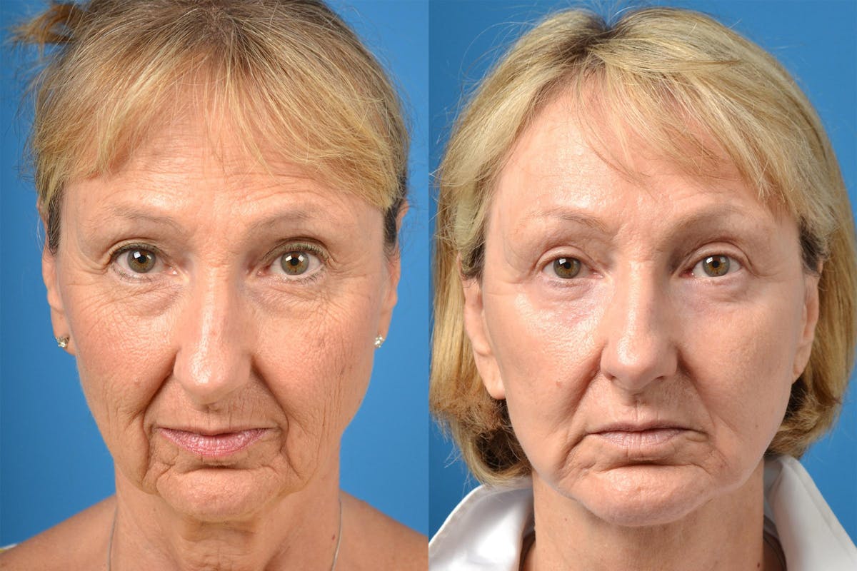 Facelift Before & After Gallery - Patient 122406019 - Image 1