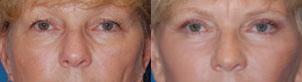 Eyelid Surgery Before & After Gallery - Patient 384947 - Image 1