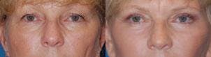 Eyelid Surgery Before & After Gallery - Patient 122406017 - Image 1