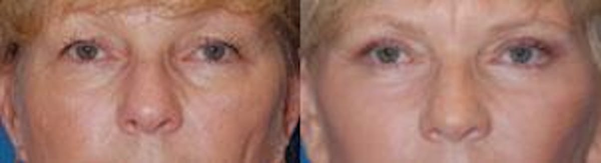 Eyelid Surgery Before & After Gallery - Patient 122406017 - Image 1