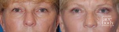 Eyelid Surgery Before & After Gallery - Patient 384947 - Image 1