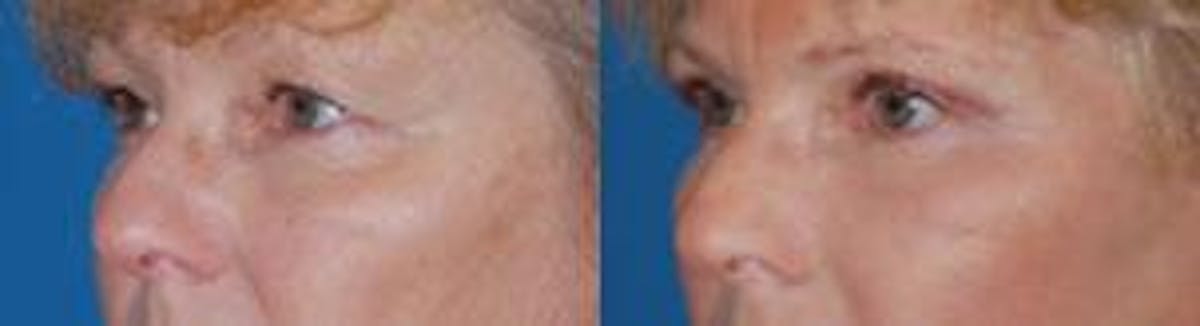 Eyelid Surgery Before & After Gallery - Patient 122406017 - Image 2