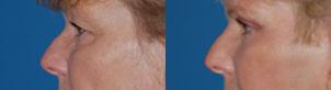 Eyelid Surgery Before & After Gallery - Patient 384947 - Image 3