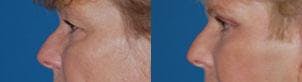 Eyelid Surgery Before & After Gallery - Patient 122406017 - Image 3