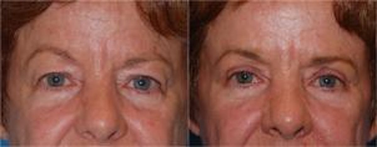 Eyelid Surgery Before & After Gallery - Patient 122406020 - Image 1