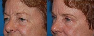 Eyelid Surgery Gallery - Patient 122406020 - Image 2