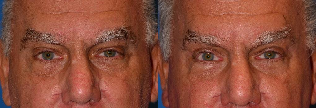 Eyelid Surgery Before & After Gallery - Patient 122406021 - Image 1