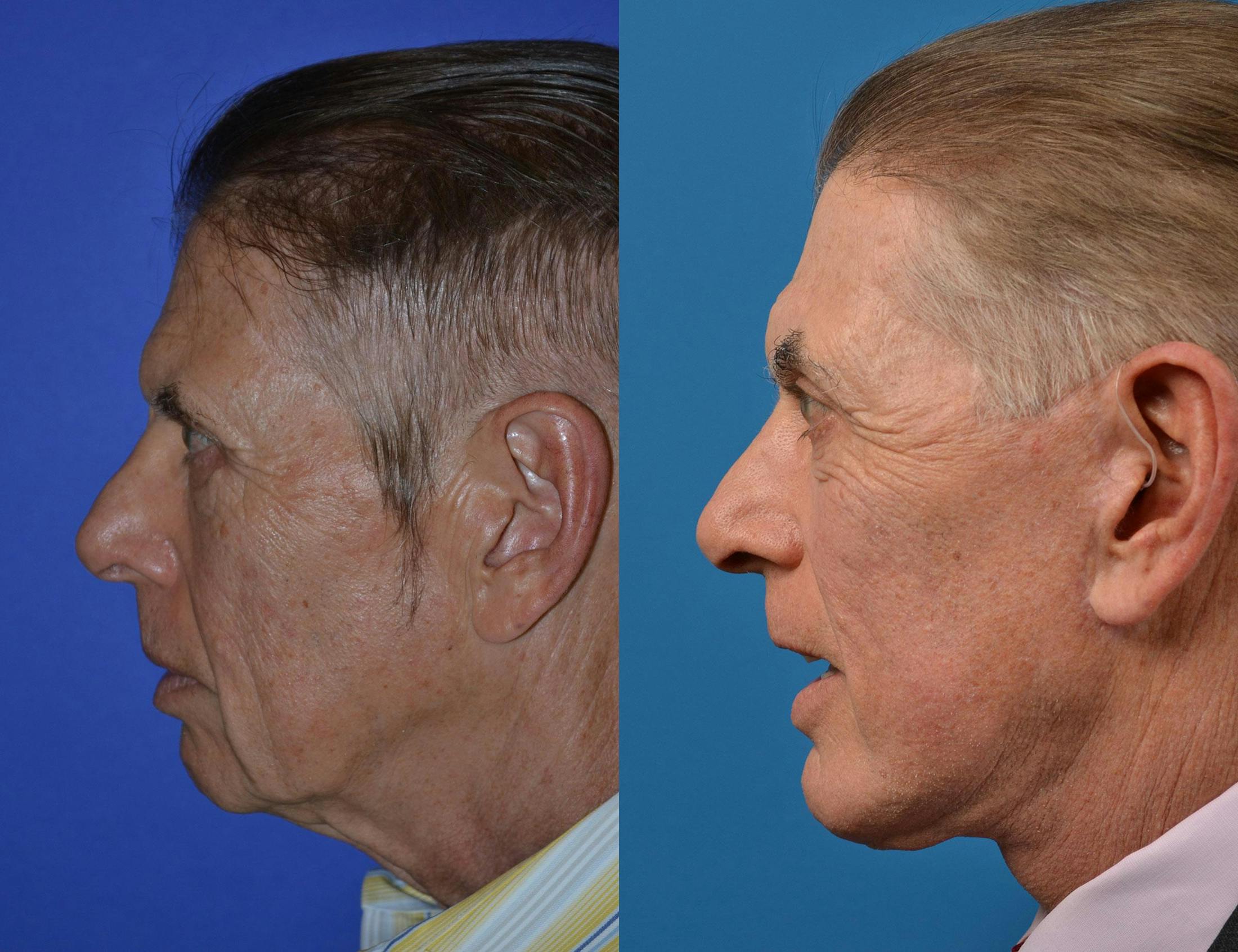 Facelift Before & After Gallery - Patient 122406025 - Image 2