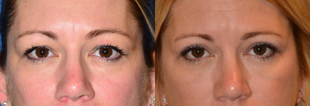 Eyelid Surgery Before & After Gallery - Patient 327371 - Image 1
