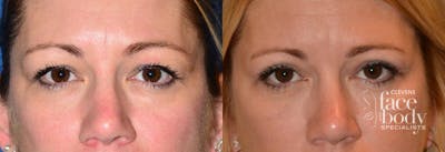 Eyelid Surgery Before & After Gallery - Patient 327371 - Image 1
