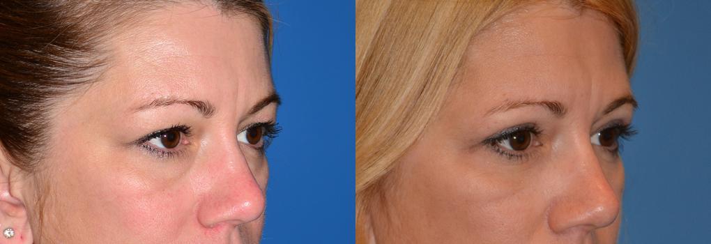Eyelid Surgery Before & After Gallery - Patient 327371 - Image 2