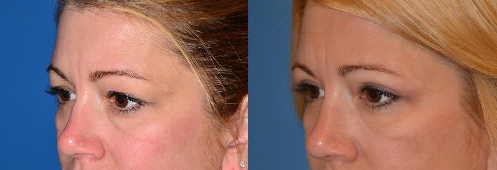 Eyelid Surgery Before & After Gallery - Patient 327371 - Image 3