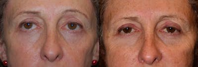 Eyelid Surgery Before & After Gallery - Patient 122406027 - Image 1