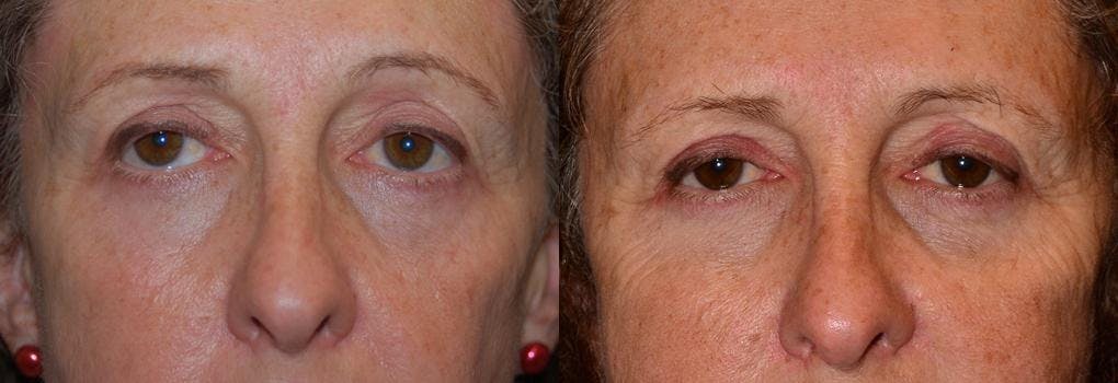 Eyelid Surgery Gallery - Patient 122406027 - Image 1