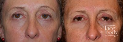Eyelid Surgery Before & After Gallery - Patient 200668 - Image 1