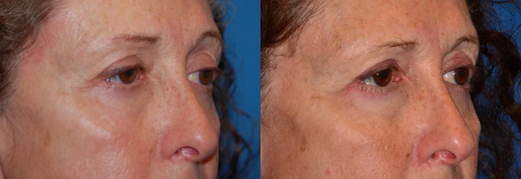 Eyelid Surgery Before & After Gallery - Patient 200668 - Image 2