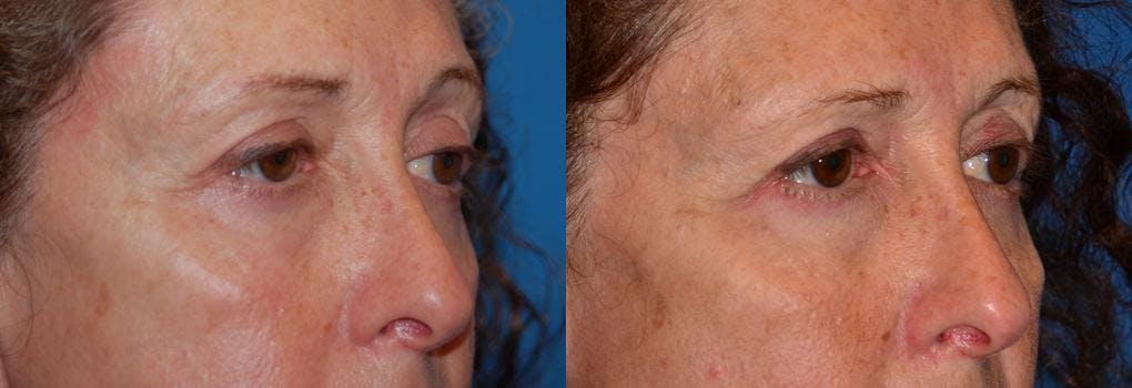 Eyelid Surgery Before & After Gallery - Patient 122406027 - Image 2