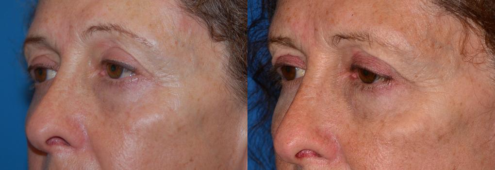 Eyelid Surgery Before & After Gallery - Patient 200668 - Image 3