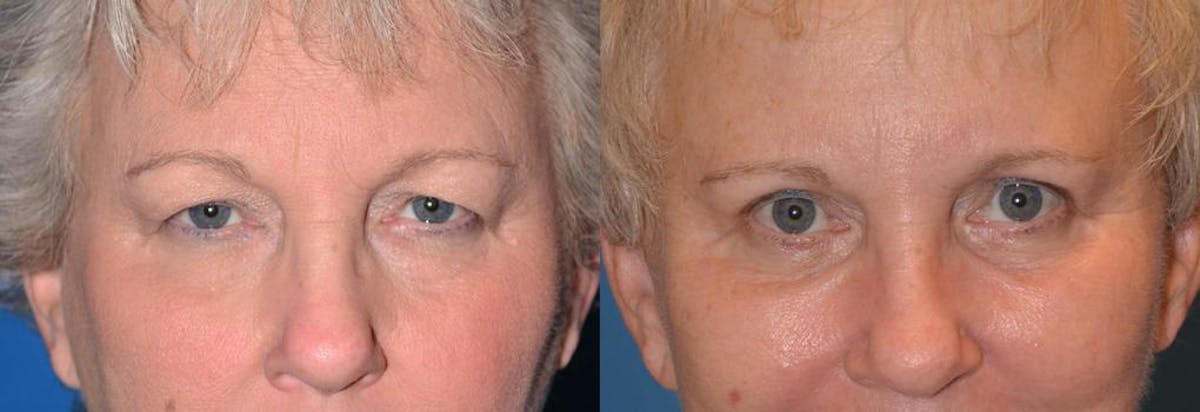 Eyelid Surgery Before & After Gallery - Patient 122406029 - Image 1