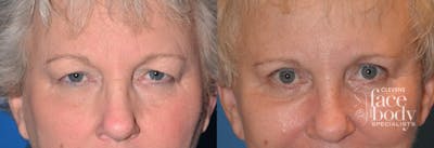 Eyelid Surgery Before & After Gallery - Patient 899915 - Image 1