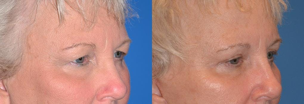 Eyelid Surgery Before & After Gallery - Patient 122406029 - Image 2