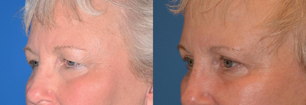 Eyelid Surgery Before & After Gallery - Patient 899915 - Image 3