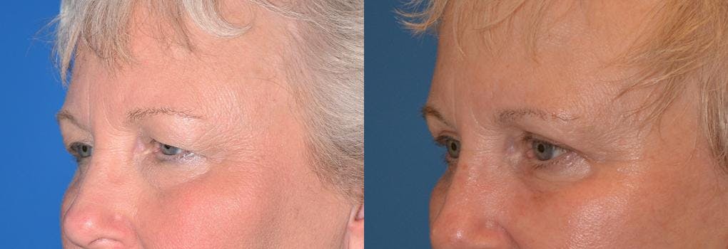 Eyelid Surgery Before & After Gallery - Patient 122406029 - Image 3