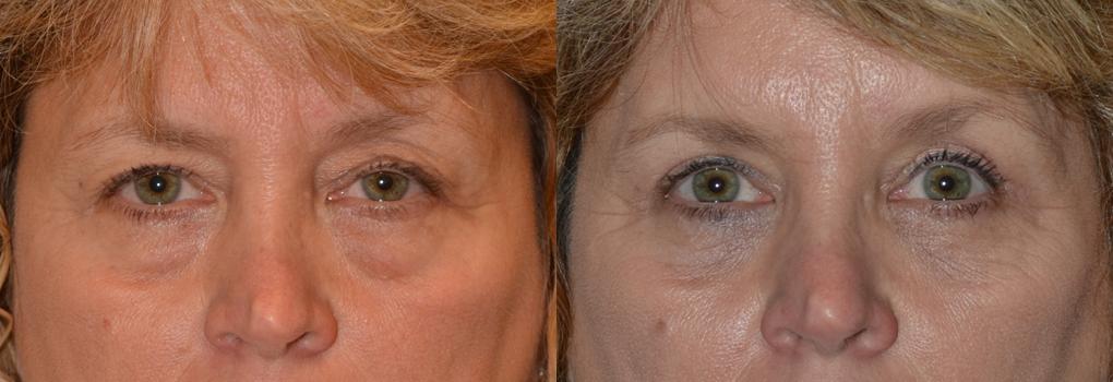 Eyelid Surgery Before & After Gallery - Patient 117348 - Image 1