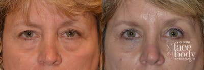 Eyelid Surgery Before & After Gallery - Patient 117348 - Image 1
