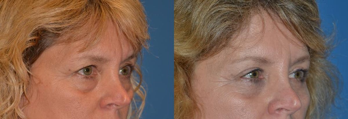 Eyelid Surgery Before & After Gallery - Patient 122406032 - Image 2