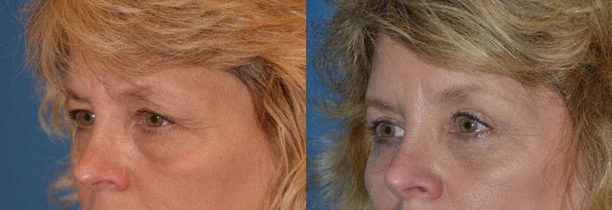 Eyelid Surgery Before & After Gallery - Patient 122406032 - Image 3