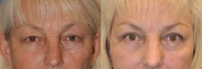 Eyelid Surgery Before & After Gallery - Patient 122406035 - Image 1