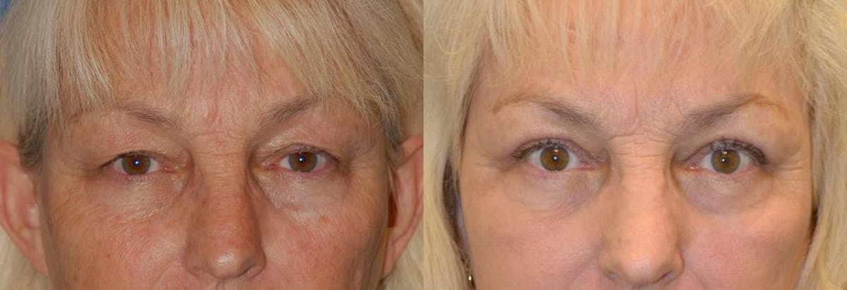Eyelid Surgery Before & After Gallery - Patient 122406035 - Image 1