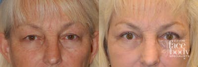 Eyelid Surgery Before & After Gallery - Patient 283578 - Image 1