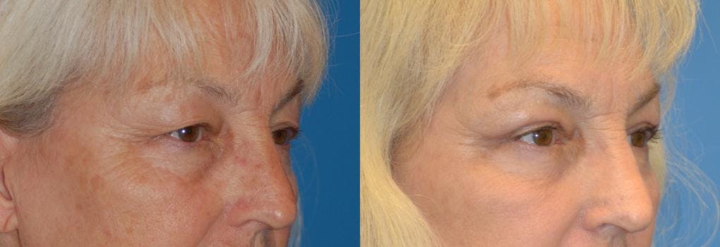 Eyelid Surgery Before & After Gallery - Patient 122406035 - Image 2