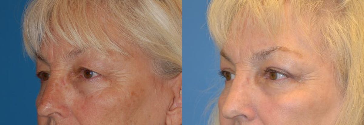 Eyelid Surgery Before & After Gallery - Patient 122406035 - Image 3