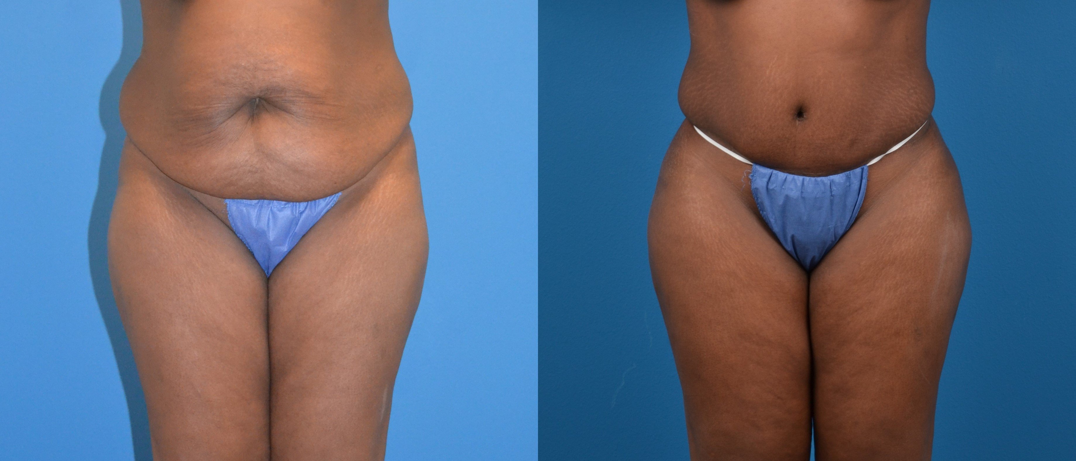 Hidden Liposuction  Before & After Gallery - Patient 197789 - Image 1