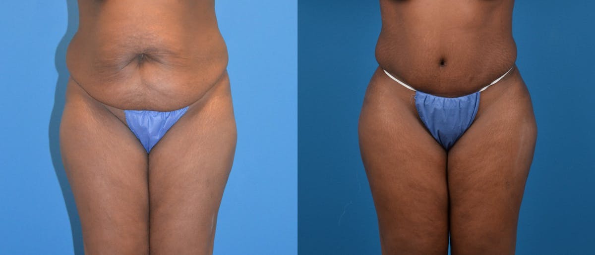 Liposuction Before & After Gallery - Patient 427888 - Image 1