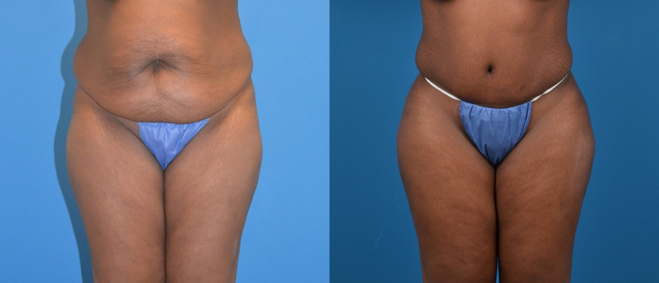 Liponique Body Contouring Before & After Gallery - Patient 122406038 - Image 1