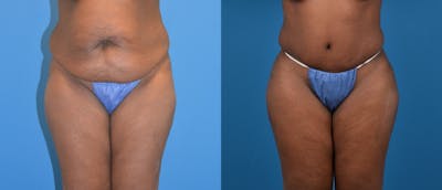 Liponique Body Contouring Before & After Gallery - Patient 122406038 - Image 1