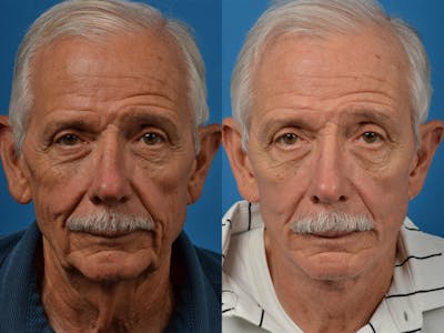 Facelift Before & After Gallery - Patient 122406041 - Image 1