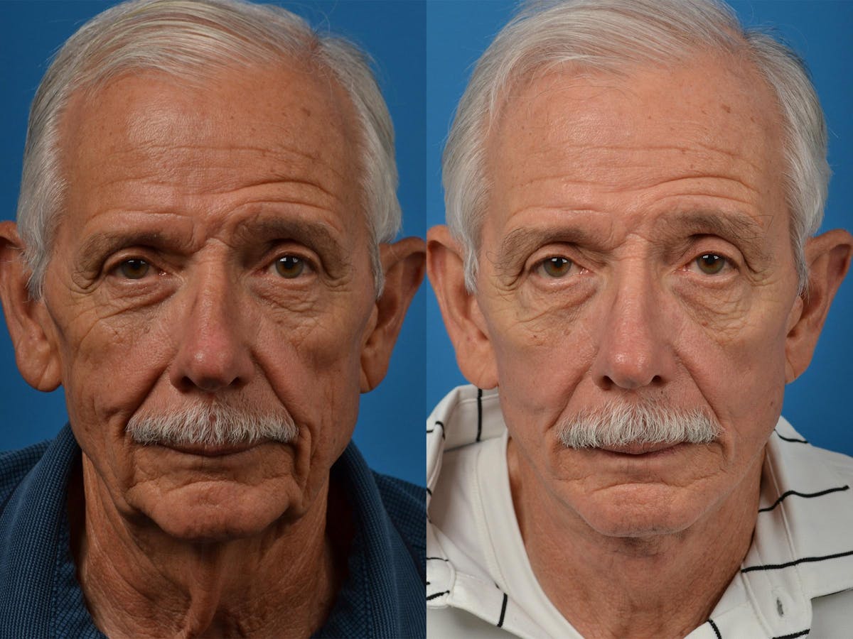 Facelift Before & After Gallery - Patient 122406041 - Image 1
