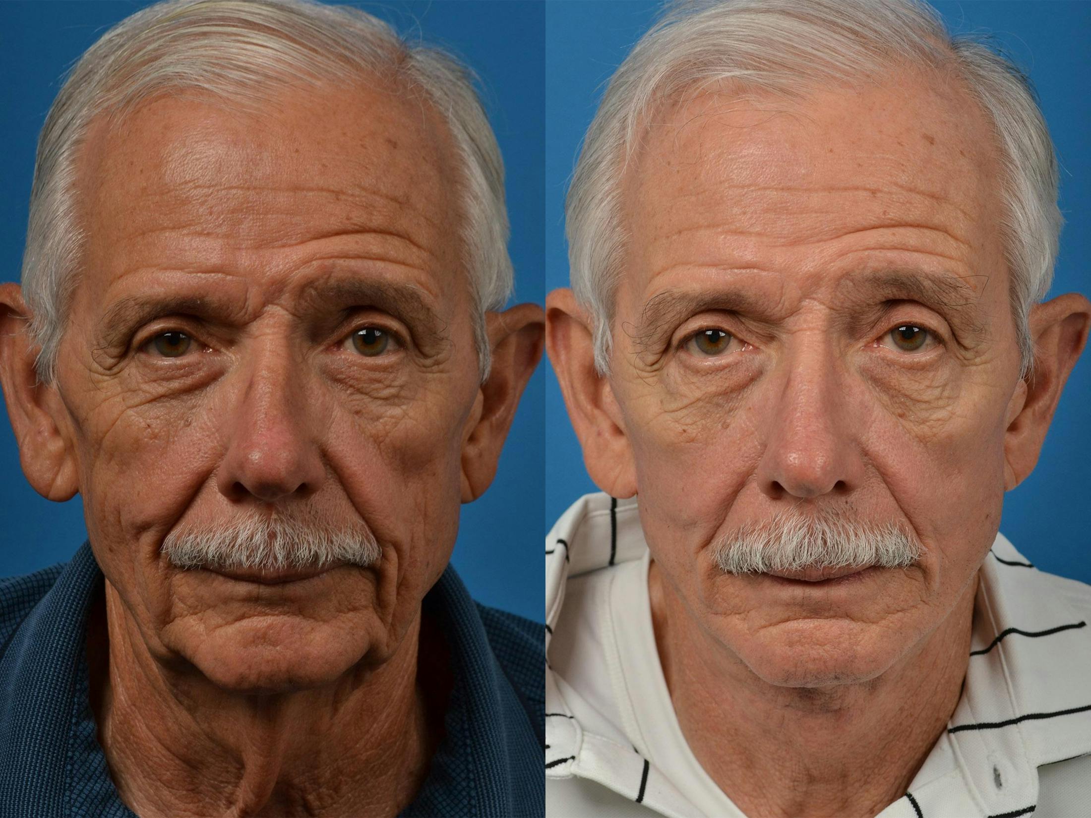 Facelift Before & After Gallery - Patient 122406041 - Image 1