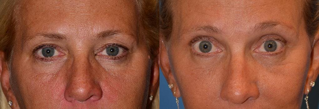 Eyelid Surgery Before & After Gallery - Patient 122406037 - Image 1