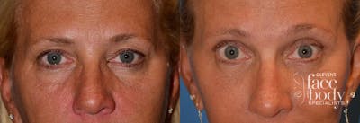 Eyelid Surgery Before & After Gallery - Patient 302279 - Image 1